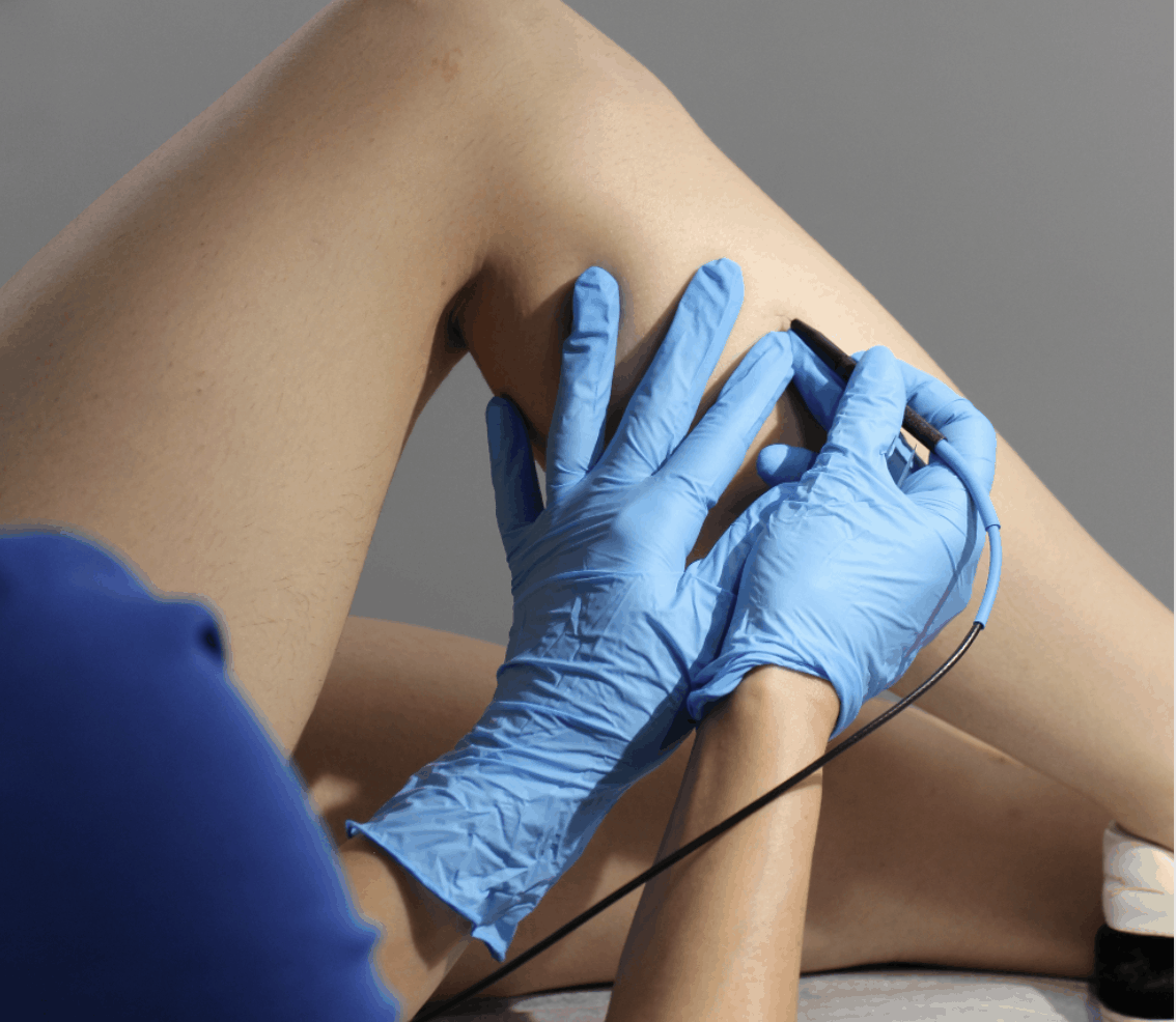 Permanent Hair Removal for Athletes: Boost Performance and Confidence