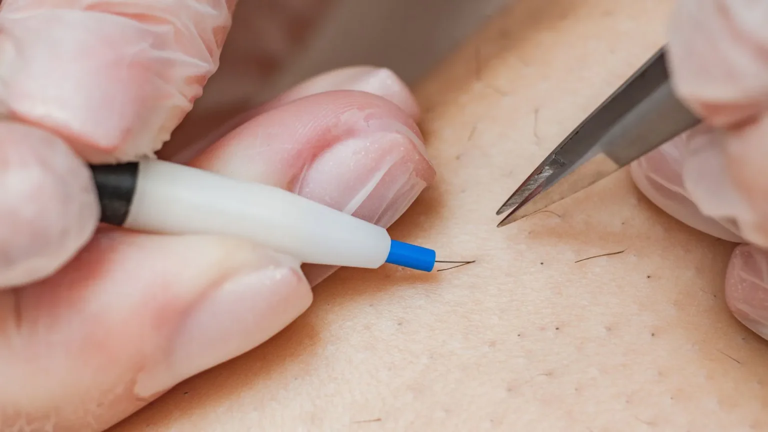 Electrolysis Hair Removal: Pros, Cons, and Why It’s Shockingly Effective!