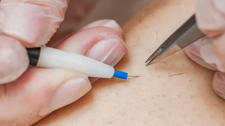 Electrolysis Hair Removal: Pros, Cons, and Why It’s Shockingly Effective!