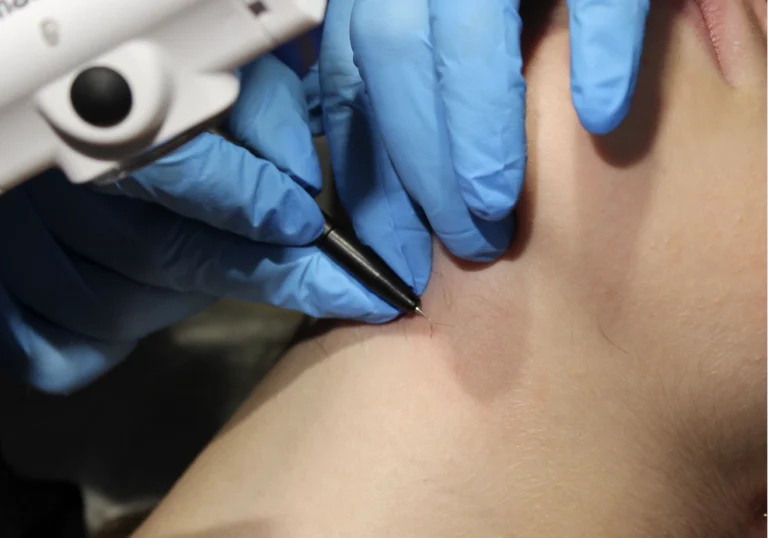 Is Electrolysis Painful? Here’s What It Really Feels Like