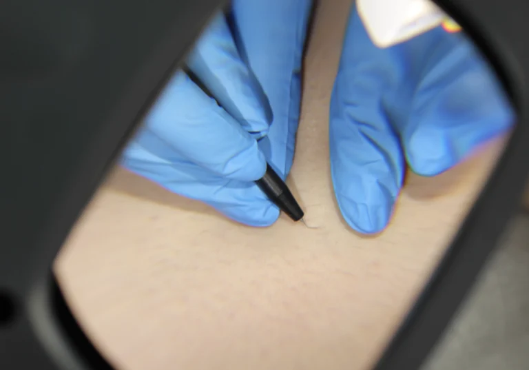 Lip Hair, Chin Hair – Gone with Electrolysis