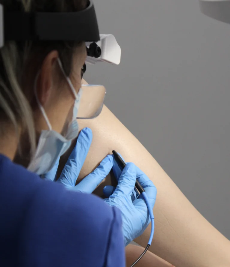 5 Possible Electrolysis Hair Removal Side Effects