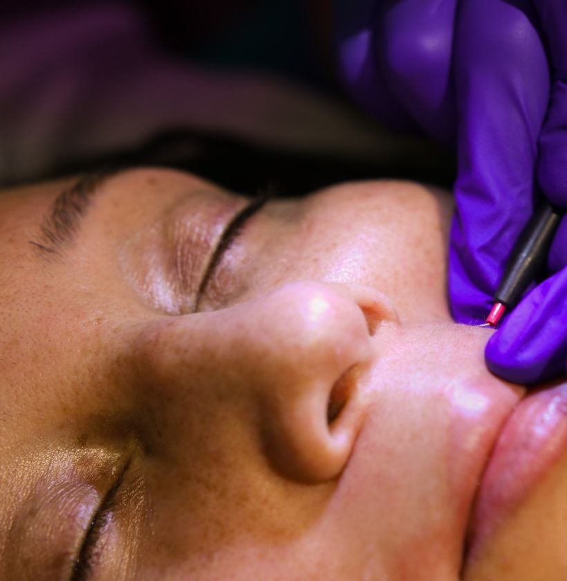 pcos related hair removal