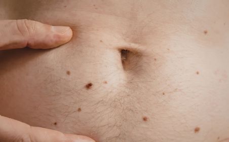 stomach hair removal permanent