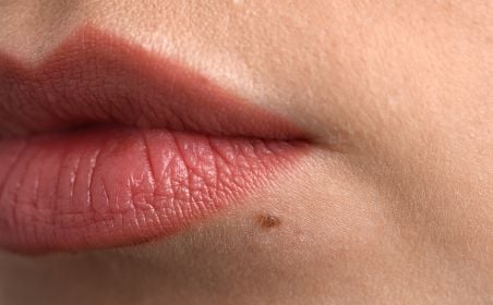 pcos related hair growth removal permanent