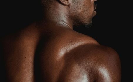 Back shoulder permanent hair removal electrolysis