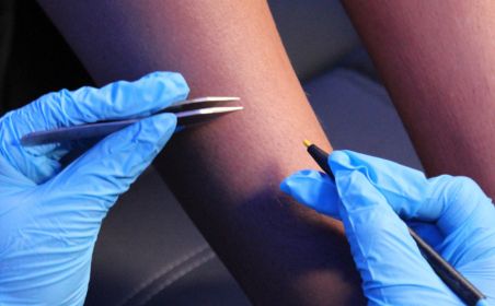 electrolysis permanent hair removal for legs