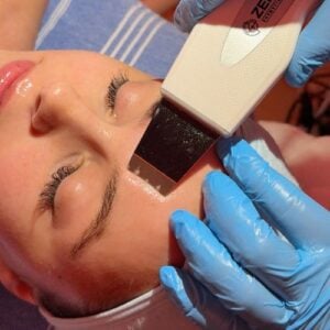 Resurfacing Chemical Peel