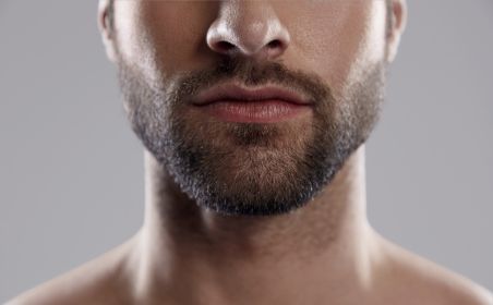 permanent electrolysis hair removal at Nios Skin Lab NYC for chin, cheek and sideburns