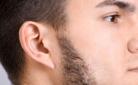 Defined sideburn line after permanent electrolysis hair removal at Nios Skin Lab NYC