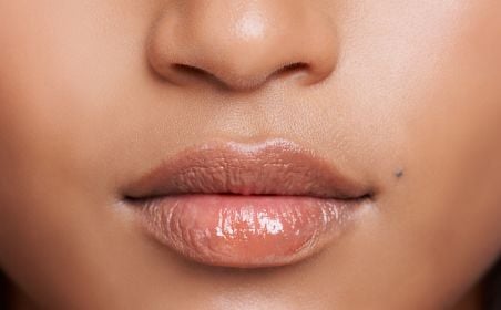 Smooth upper lip after permanent electrolysis hair removal at Nios Skin Lab NYC