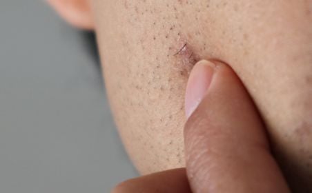 ingrown hair removal and razor bumps with electrolysis