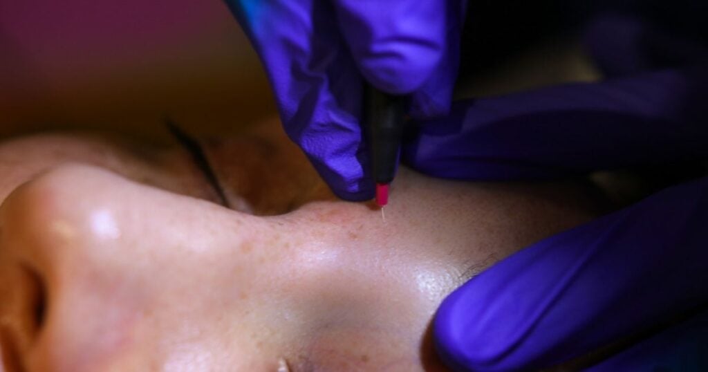 Client comfortable during electrolysis session at Nios Skin Lab NYC