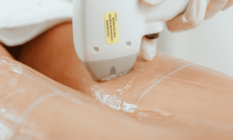 why you can still have hair after laser hair removal