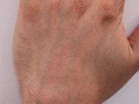 electrolysis hand hair removal after