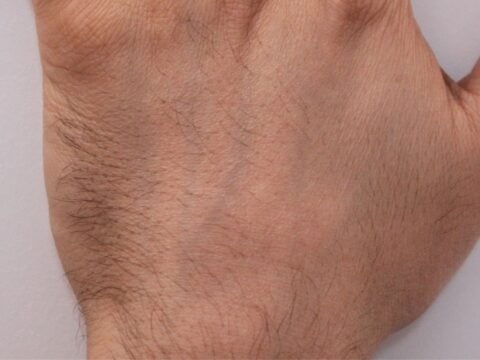 electrolysis hand hair removal before