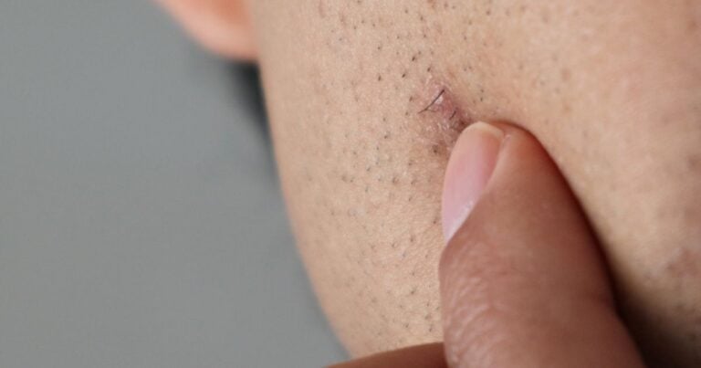 how to get rid on an ingrown hair