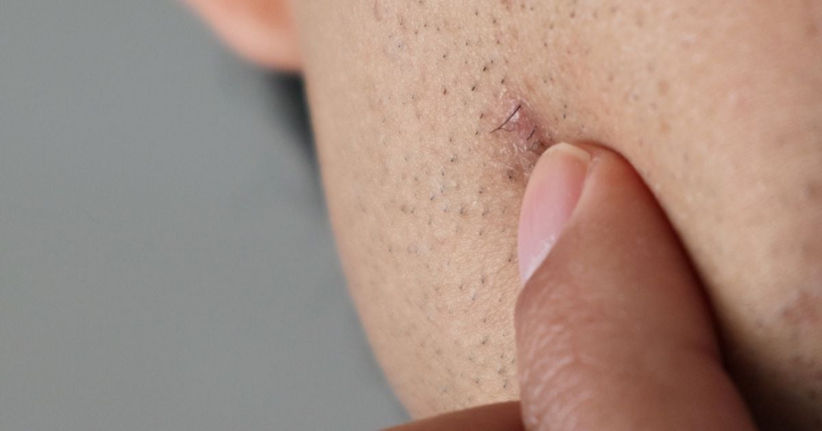 how to get rid on an ingrown hair