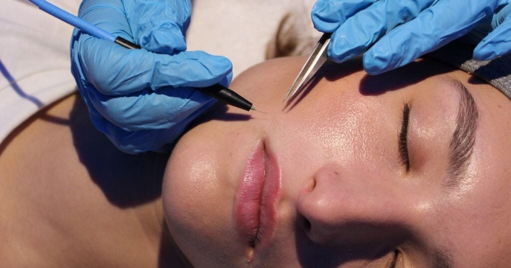electrolysis hair removal