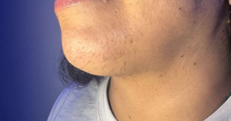 Permanent chin hair removal with electrolysis at Nios Skin Lab NYC