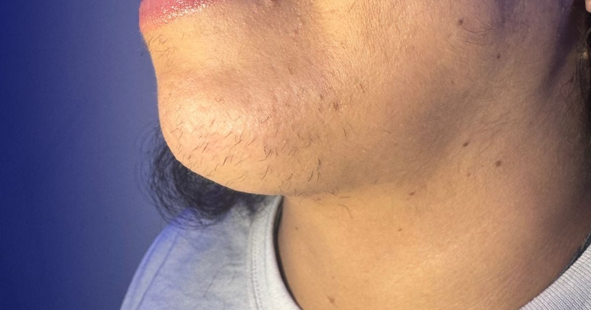 Permanent chin hair removal with electrolysis at Nios Skin Lab NYC