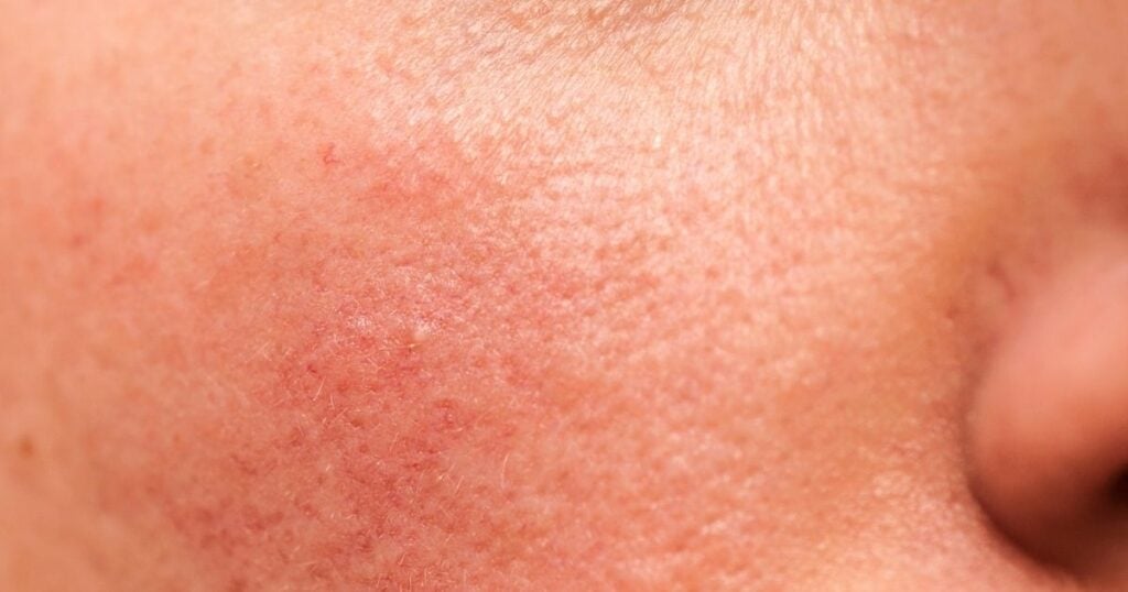 Persistent redness and tightness, common signs of a damaged skin barrier