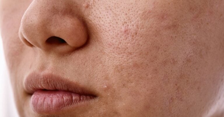 Persistent redness and tightness, common signs of a damaged skin barrier