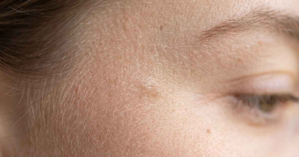 peach fuzz hair removal nyc