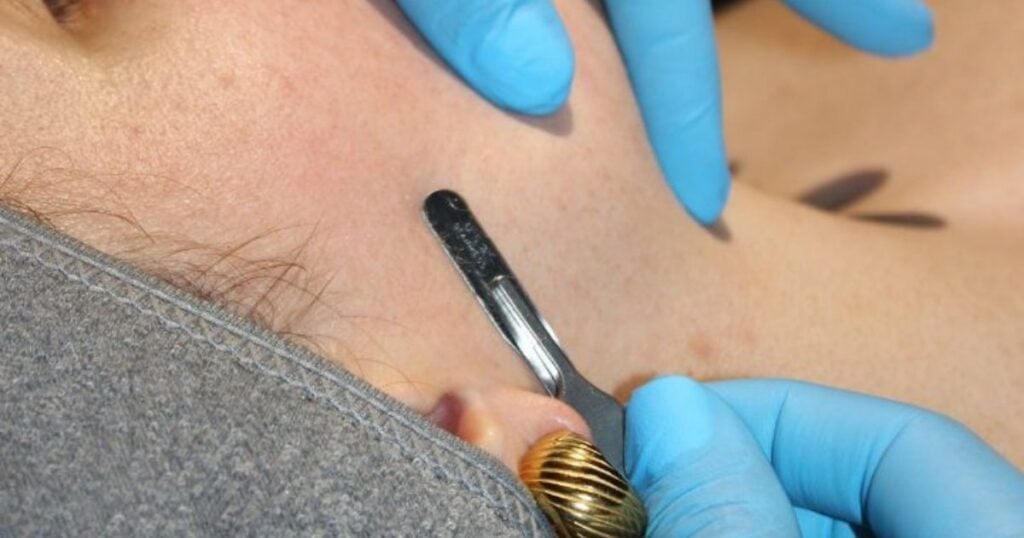 Close-up of a dermaplaning blade gliding along a client's cheek near the jaw